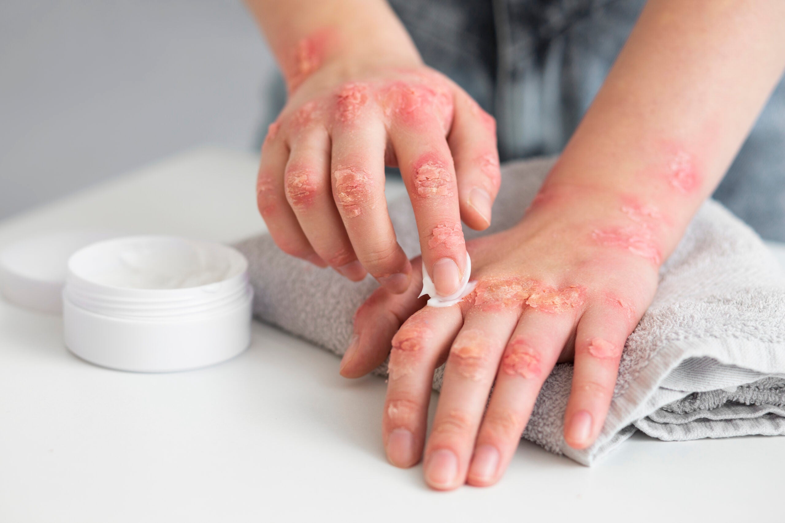 Why your skin keeps itching- what Ayurveda says about the root cause and how Allergygavyam helps